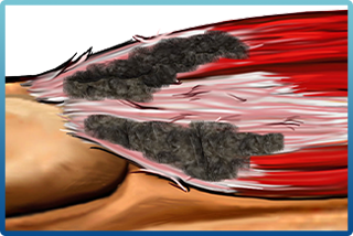 Tendinosis degenerated tendon fiber diagram