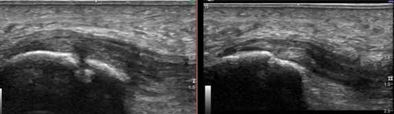 Musuloskeletal ultrasound showing plantar fasciosis before TenJet treatment, and healed tissue after